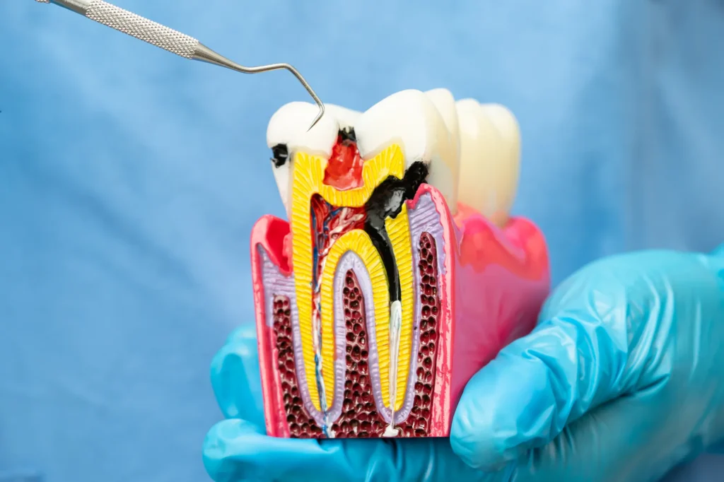 Primo piano di un modello anatomico dentale in sezione tenuto da una mano con guanto blu. Un sondino parodontale indica la zona della carie, visibile in nero, che penetra attraverso lo smalto fino alla polpa dentale. Il modello mostra la struttura interna del dente con dentina in giallo, polpa rossa, canali radicolari e osso spugnoso circostante. Sfondo azzurro.