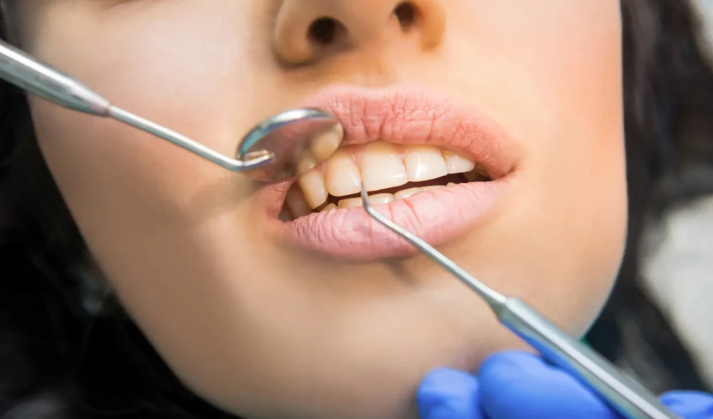 Primo piano della bocca di una paziente durante una visita odontoiatrica. Uno specchietto e una sonda dentale vengono utilizzati per esaminare i denti anteriori superiori e inferiori. Si intravede la mano del dentista con guanto blu.