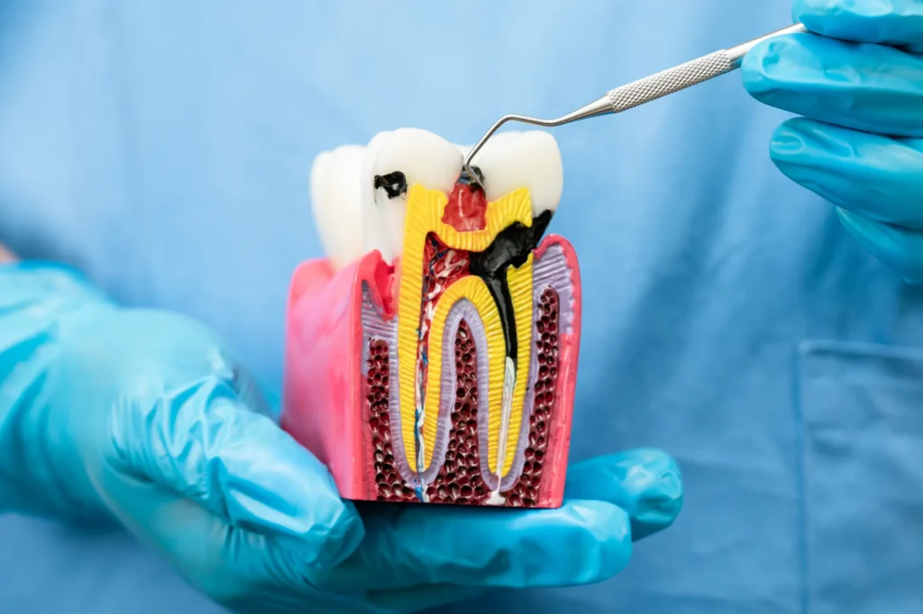 Mani di un dentista con guanti blu che tengono un modello anatomico in sezione di denti, mostrando la struttura interna con polpa, radici e osso spugnoso. Uno dei denti presenta una carie profonda evidenziata in nero, mentre accanto è visibile un dente sano. Un sondino parodontale è appoggiato sulla superficie del modello.