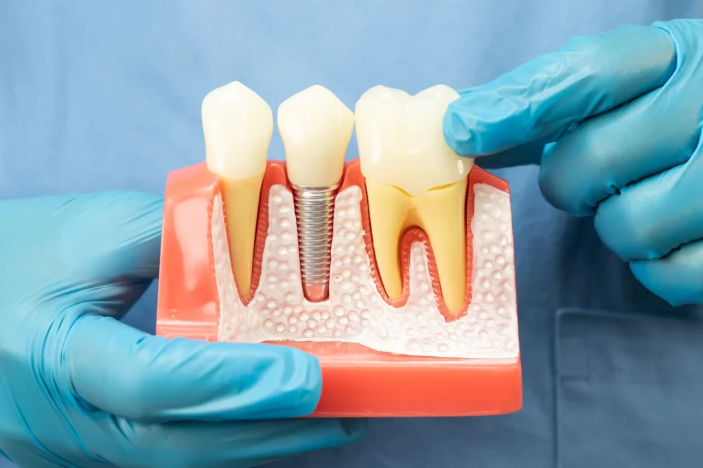 Mani con guanti blu che tengono un modello anatomico in sezione raffigurante tre denti: al centro un impianto dentale con vite in titanio inserita nell'osso e corona protesica rimovibile, affiancato da due denti naturali con radici visibili. Sfondo azzurro.