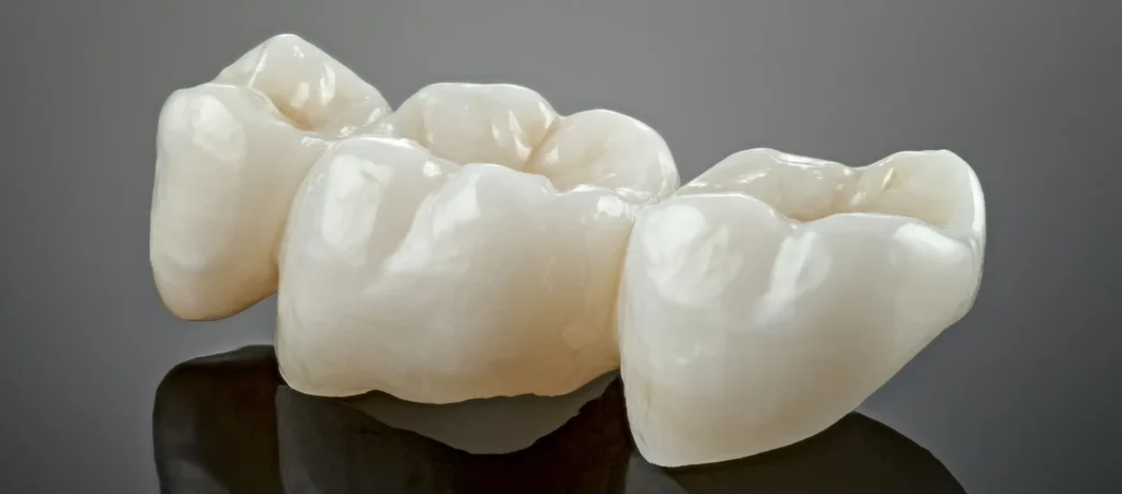 Primo piano di un ponte dentale in ceramica bianca composto da tre elementi, appoggiato su una superficie scura riflettente con sfondo grigio. La protesi fissa mostra la superficie occlusale lucida e la forma anatomica dei denti posteriori.