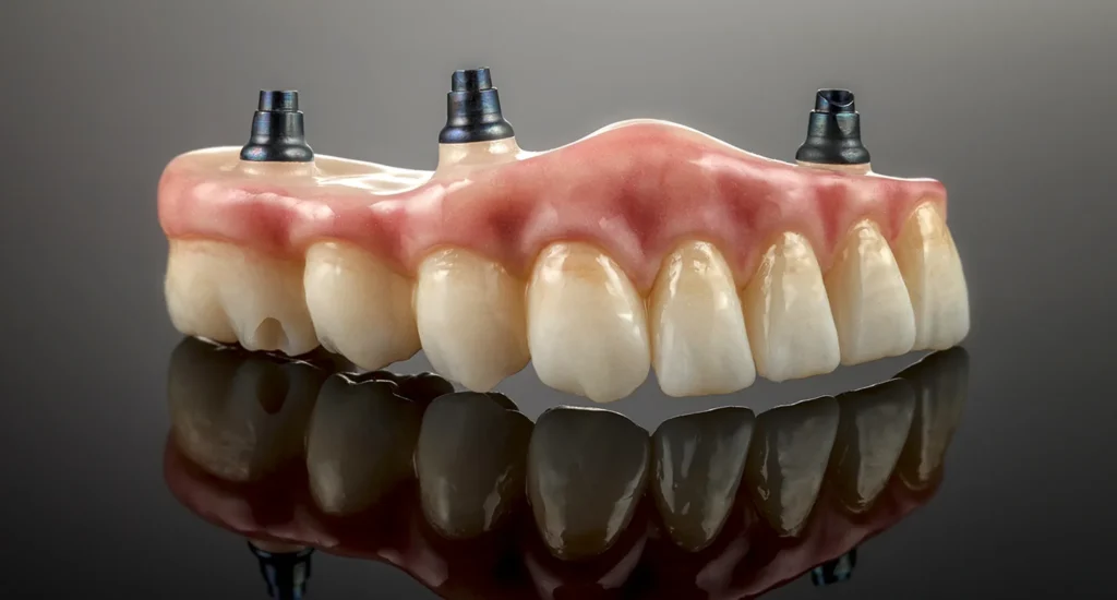 Protesi dentale superiore completa supportata da tre impianti, appoggiata su una superficie scura riflettente. Si vedono i denti protesici bianchi, la gengiva artificiale rosa e i tre attacchi metallici nella parte superiore per il fissaggio agli impianti.