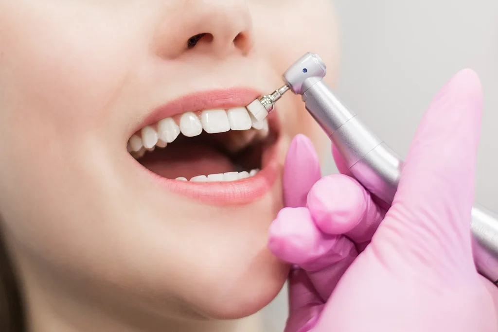 Primo piano della bocca di una paziente durante una seduta di igiene orale professionale. La mano dell'igienista dentale, con guanto rosa, utilizza un manipolo con coppetta per la lucidatura dei denti anteriori superiori.