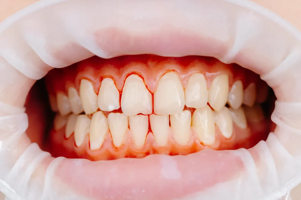 Primo piano della bocca di un paziente con divaricatore labiale, che mostra gengive arrossate e sanguinanti attorno ai denti anteriori superiori e inferiori. Tracce di sangue sono visibili lungo il margine gengivale e negli spazi interdentali, segno di infiammazione parodontale.