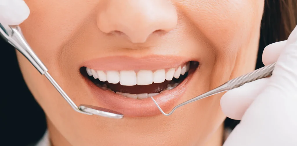Primo piano del sorriso di una paziente con denti bianchi e allineati, mentre le mani del dentista con guanti bianchi tengono uno specchietto e una sonda parodontale ai lati della bocca durante una visita di controllo.