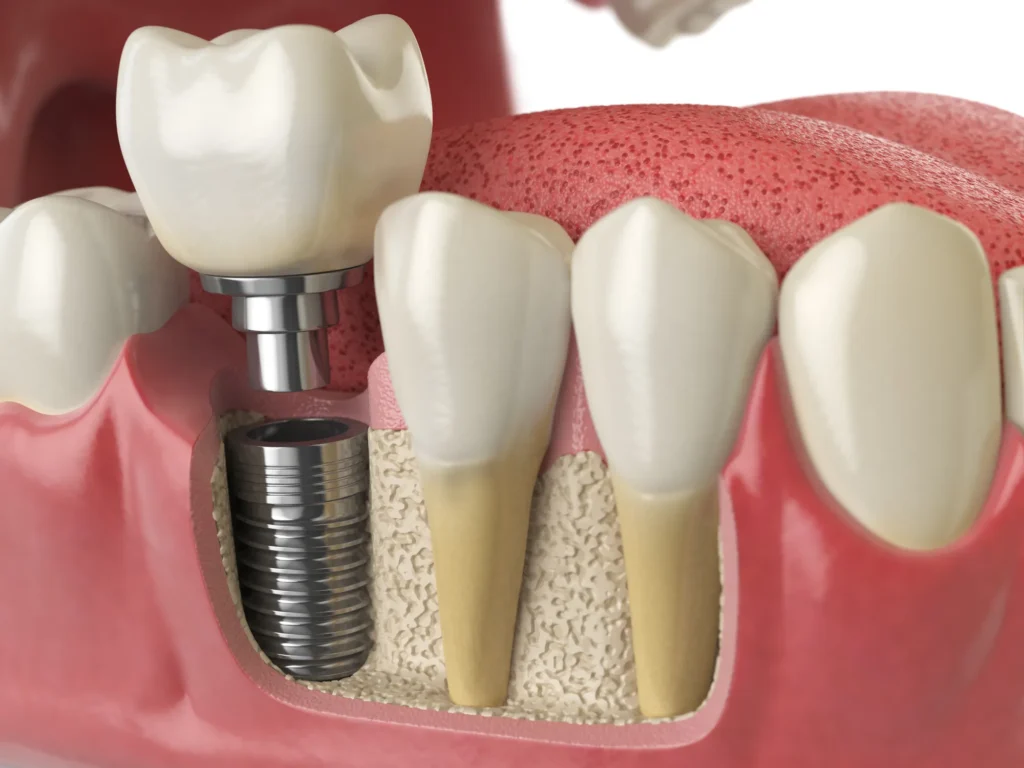Rendering 3D in sezione di un impianto dentale inserito nell'osso mandibolare, che mostra la vite endossea in titanio, l'abutment e la corona protesica bianca. Accanto, denti naturali con radici visibili nell'osso spugnoso e gengiva rosa.
